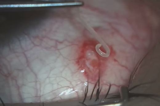 
Quá trình con giun ở trong mắt và sau khi được lấy ra. (Ảnh: Chụp màn hình)