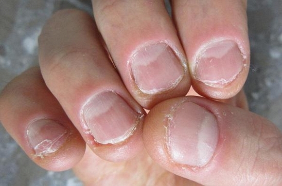 
Các kẽ tay khi bị cắn sẽ bị tổn thương dẫn đến viêm nhiễm, làm mủ thậm chí thối rửa ngón tay. 