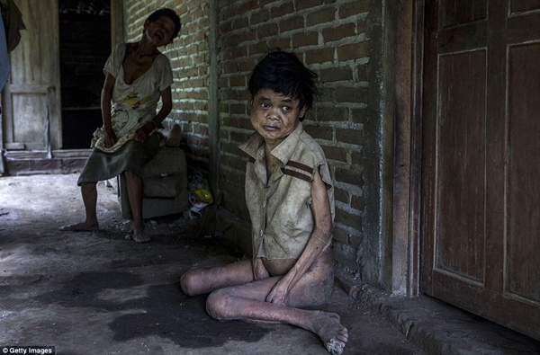 
Sinem, một bệnh nhân Down tại làng Krebet, Jambon, ngồi trên sàn nhà dơ bẩn, ướt át. (Ảnh: Daily Mail)