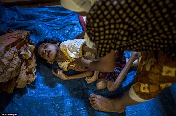 
Những đứa trẻ bị mắc bệnh Down giống như cô bé Jamila này là rất nhiều ở Indonesia. (Ảnh: Daily Mail)