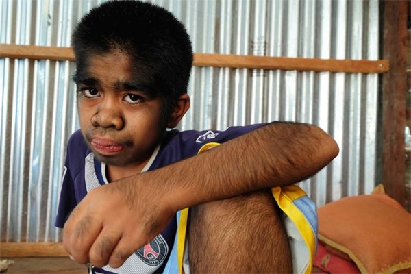 
Cậu thiếu niên "người sói" này là Hirsute Muhammad Raihan, 13 tuổi. (Ảnh: Internet)