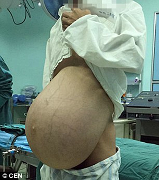 
Chiếc bụng to khủng khiếp của bệnh nhân (Ảnh: Internet)