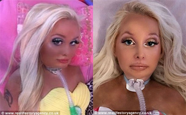 Barbie phiên bản người thật bị bại liệt đầu tiên trên thế giới