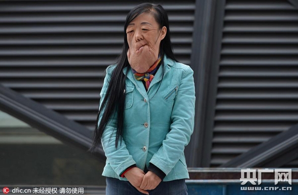 
Người phụ nữ này có họ là Lưu, 47 tuổi, có một khối u rất lớn trên mặt khiến cho phần mặt dưới biến dạng, chảy xệ xuống tận ức.