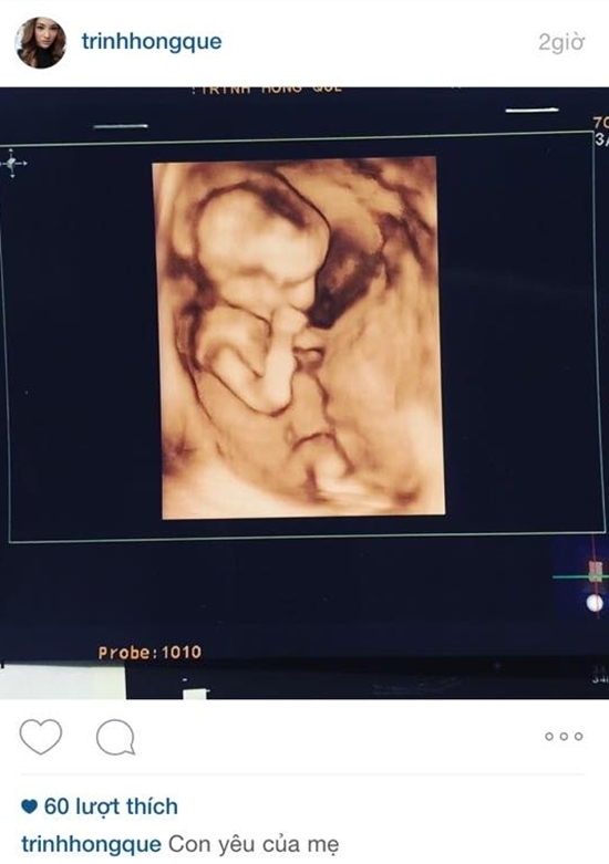 
Hình ảnh trên Instagram của Hồng Quế tối qua khi đăng một bức ảnh chụp kết quả thai nhi kèm theo dòng trạng thái: "Con yêu của mẹ", gây xôn xao dư luận. Tuy nhiên chỉ trong vòng vài phút, Hồng Quế ngay lập tức khóa tài khoản Instagram. - Tin sao Viet - Tin tuc sao Viet - Scandal sao Viet - Tin tuc cua Sao - Tin cua Sao