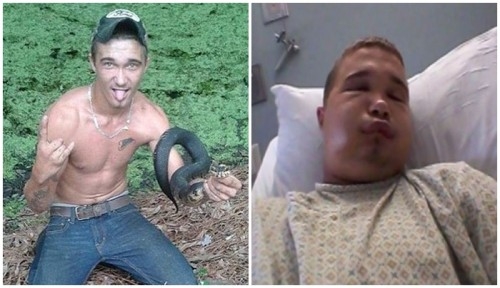 
Anh chàng Austin trước và sau khi bị rắn độc cắn.
