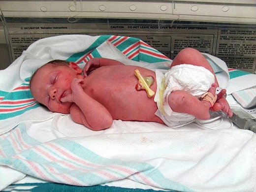 
Jemma khi ra đời không may mắc chứng dị tật di truyền. (Ảnh: Internet)