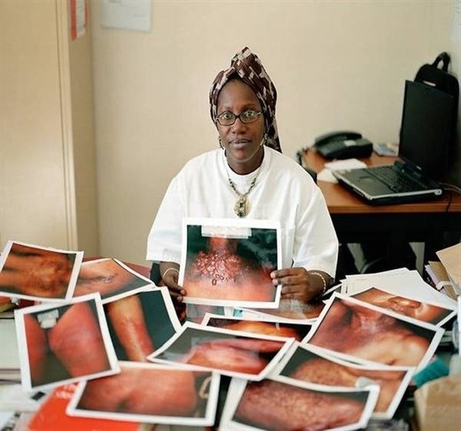 
Bác sĩ da liễu tại bệnh viện Dakar đưa ra những bức ảnh nạn nhân dùng tẩy trắng. Bà cho hay hầu hết họ đều không ý thức được về việc phải là chất độc hại mới có thể tẩy trắng da.