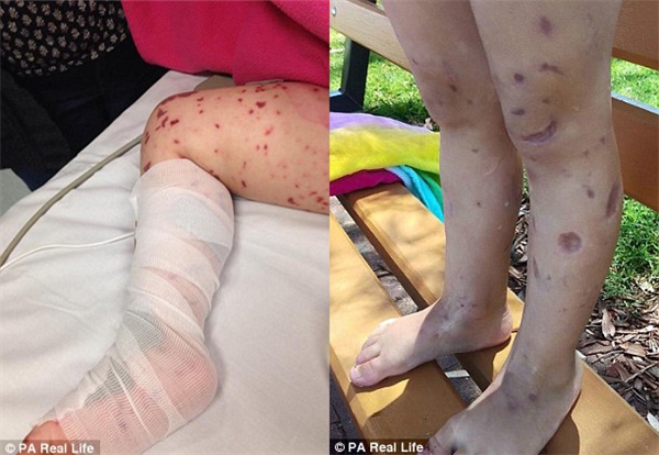
Đôi chân bị "tàn phá" nặng nề sau khi được chữa trị của bé Jazmyn