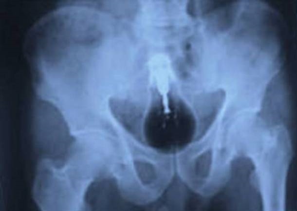 
Khi các bác sĩ ở Pakistan lấy chiếc bóng đèn ra khỏi bụng một bệnh nhân, anh ta ngây ngô trả lời rằng không biết vì sao nó lại nằm ở đó. Tất nhiên ai cũng thừa hiểu nó đi vào bằng đường hậu môn.