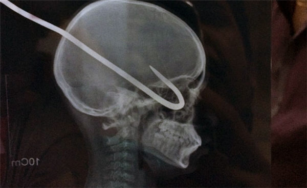 
Hình chụp hiện trạng của chiếc móc sắt trong đầu cậu bé. (Ảnh: Internet)