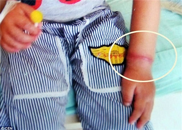 
Vết hằn đỏ trên cổ tay cậu bé