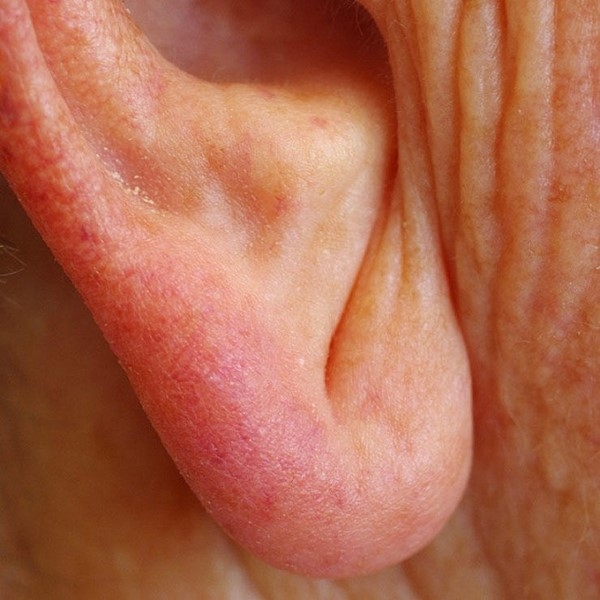 
Nguy cơ mắc bệnh động mạch vành khi có lằn chéo ở dái tai. (Ảnh: Internet)