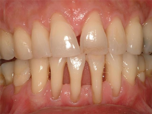 
Bệnh gây mất thẩm mỹ răng và hôi miệng. (Ảnh: Internet)