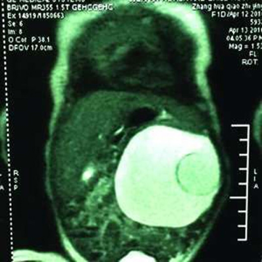 
Hình ảnh siêu âm bào thai nằm bên trong bụng em bé.