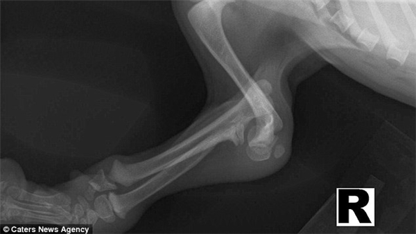 
Ảnh chụp X-quang cho thấy phần xương gánh bị cong của Wanda, thứ đã khiến bé suýt thì bị giết khi chỉ mới 4 tháng tuổi.