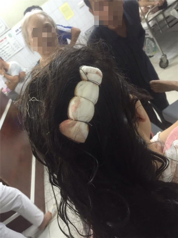 
Cô gái đăng hình mình bị thương, phải khâu gần chục mũi trên đầu để cảnh báo mọi người.(Ảnh: Internet)