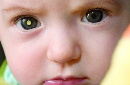 
Nếu ảnh chụp một em bé mà bạn thấy chỉ một bên mắt phản xạ lại ánh sáng hoặc có màu đỏ thì đó là dấu hiệu của bệnh ung thư võng mạc.
