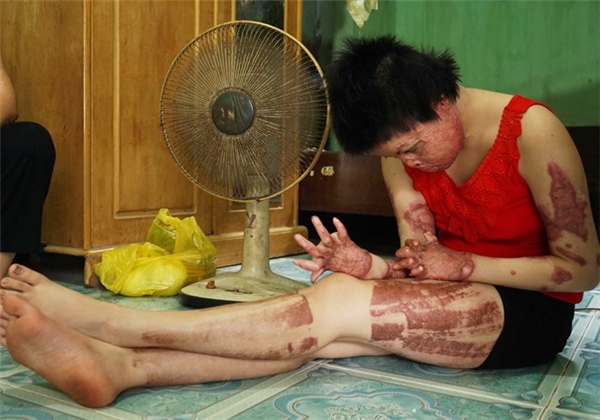 
Từ một cô gái xinh đẹp, gương mặt của Thùy Dung đã bị biến dạng vì chồng tẩm xăng đốt. (Ảnh: Internet)