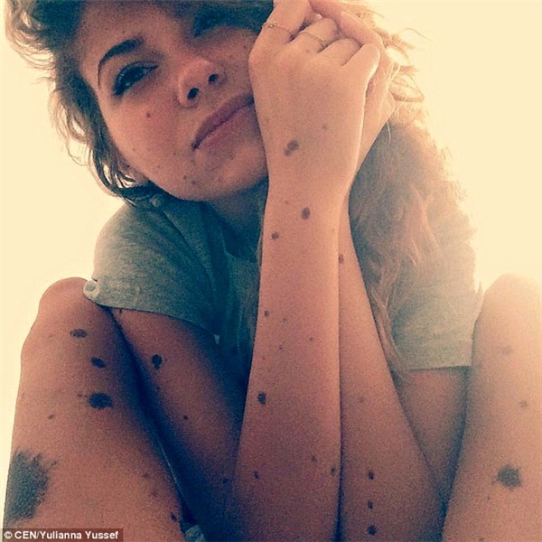 Cô gái toàn thân phủ kín nốt ruồi trở thành ngôi sao Instagram