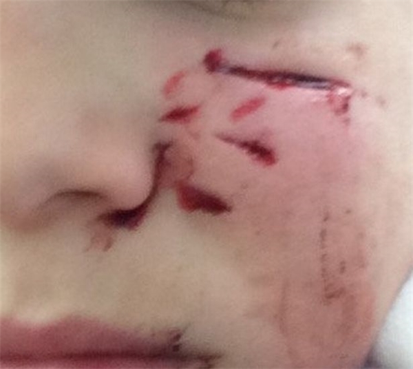 
Cận cảnh vết thương trên mặt cậu bé 11 tuổi. (Ảnh Internet)