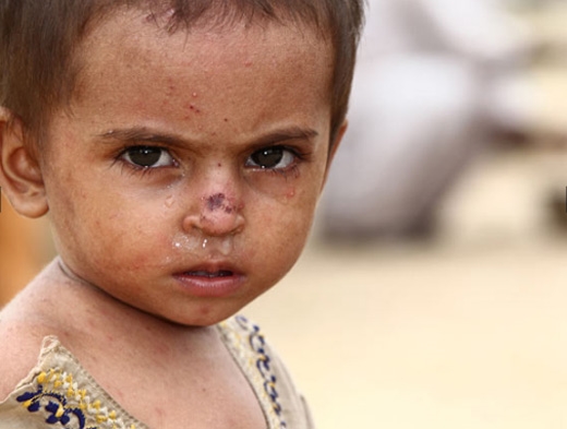 
Một đứa trẻ đang chờ đợi được chữa trị ở Thatta.