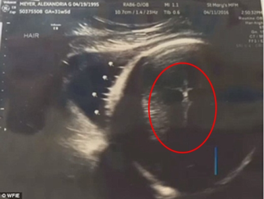 
Vào tháng 4, một bà mẹ trẻ đang sống tại Evansville, bang Indiana, Mỹ đã khiến cộng đồng mạng bán tín bán nghi khi chia sẻ hình ảnh siêu âm có dấu hiệu "Thánh" xuất hiện rất rõ ngay bên cạnh thai nhi.