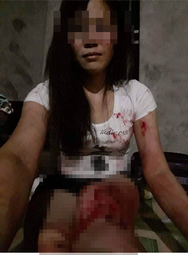 Xót xa phụ nữ bị chồng đánh phải lấy kim tự khâu vết thương cho mình