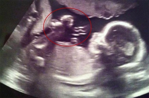 
Bức ảnh siêu âm thai nhi với hình ảnh thiên thần đang xuất hiện.