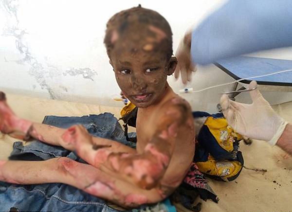 Ánh mắt ám ảnh của bé trai Syria bị trúng bom rúng động thế giới