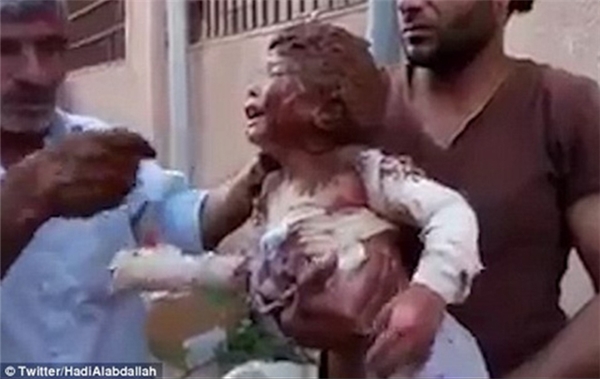 Ánh mắt ám ảnh của bé trai Syria bị trúng bom rúng động thế giới