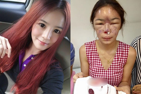 
Hot girl Thái Lan Tawanrat Fah Chaiamnuay xinh đẹp trước khi phẫu thuật thẩm mĩ và hình ảnh tàn tạ sau khi đụng đến dao kéo.