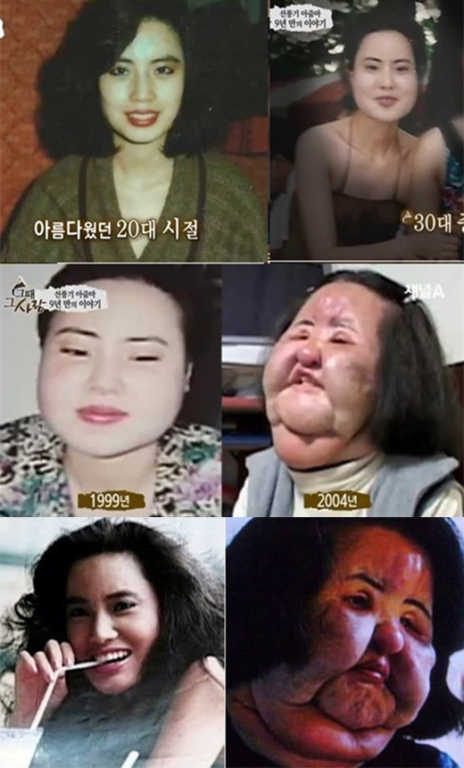 
Sau hơn 20 lần lên bàn phẫu thuật thẩm mĩ chỉnh sửa khuôn mặt, nữ ca sĩ Han Min Ok đã phải gánh chịu gương mặt phù nề biến dạng đến đáng sợ.