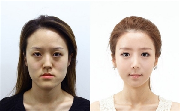 
Gương mặt trước và sau khi phẫu thuật thẩm mĩ.