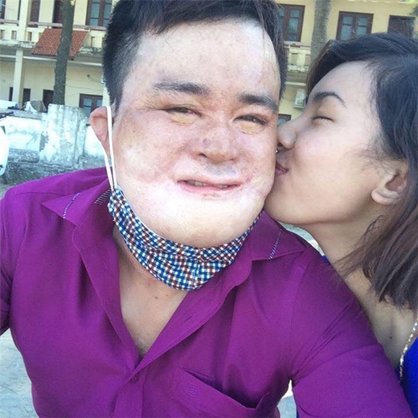 Vụ cháy nổ bình gas tại Hà Nội đã khiến anh bị bỏng nặng toàn thân và khuôn mặt biến dạng gần như hoàn toàn.