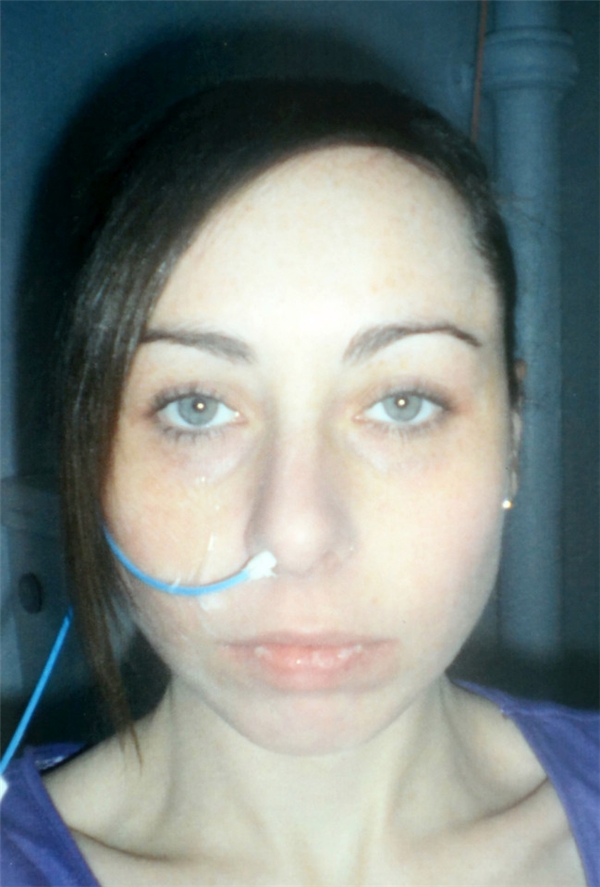 
Hình ảnh của cô vào năm 2011, lúc mới được chẩn đoán, phải truyền chất dinh dưỡng qua đường mũi.
