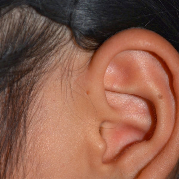 
Tùy vào từng giống người khác nhau mà tỷ lệ người được sinh ra có chiếc lỗ trên tai sẽ nhiều ít khác nhau.