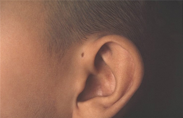 
Thông thường chiếc lỗ này chỉ xuất hiện ở một bên tai, nhưng có đến 25-50% số trường hợp có lỗ ở cả hai bên tai.