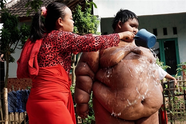 
Đây là Arya Permana (10 tuổi, Indonesia). Với cận nặng 192kg, Arya đang mang trong người căn bệnh béo phì. Vì thế cậu bé đã gặp phải rất nhiều khó khăn trong sinh hoạt hằng ngày, thậm chí Arya không thể đến trường như bạn bè đồng trang lứa. Việc làm hằng ngày của cậu bé là nằm trên sàn và chơi điện tử.