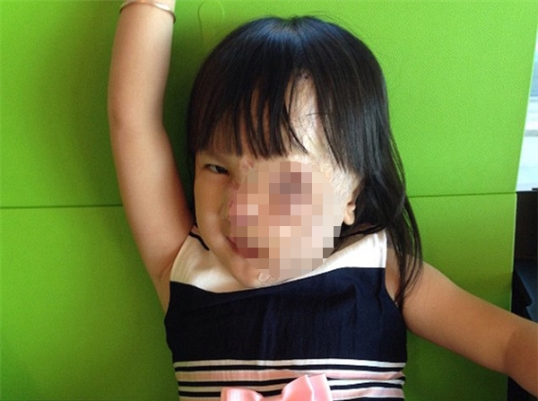 
Hai ca phẫu thuật đã đem lại diện mạo mới cho bé gái 5 tuổi.