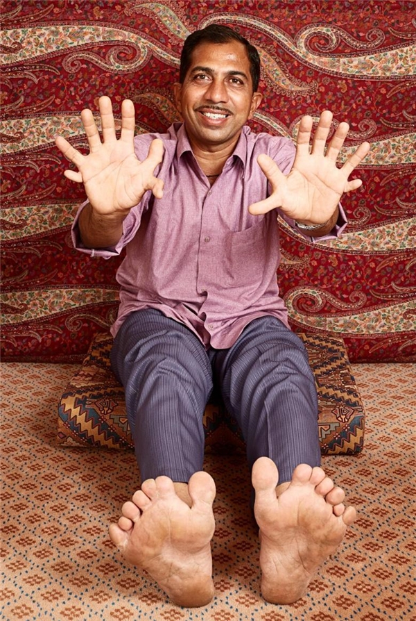 
Người có nhiều ngón tay ngón chân nhất: Devendra Suthar (người Ấn Độ) với 14 ngón tay và 14 ngón chân
