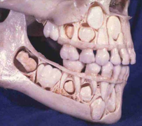 
Hộp sọ của trẻ em khi chưa thay răng sữa. (Ảnh: internet) 