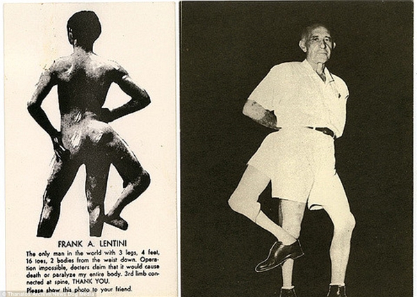 
Trong ảnh là Frank Lentini được biết đến 3 cái chân từ khi mới sinh ra.