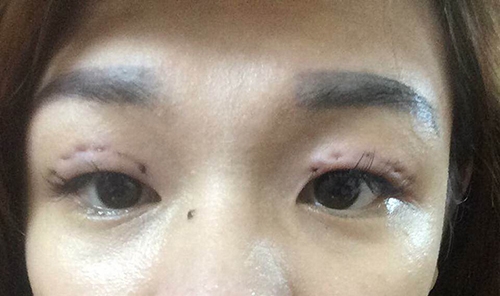 
Những vết sẹo để lại sau khi muốn "biến hóa" đôi mắt 
